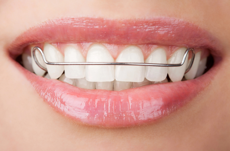 Functional Braces 4 of 3