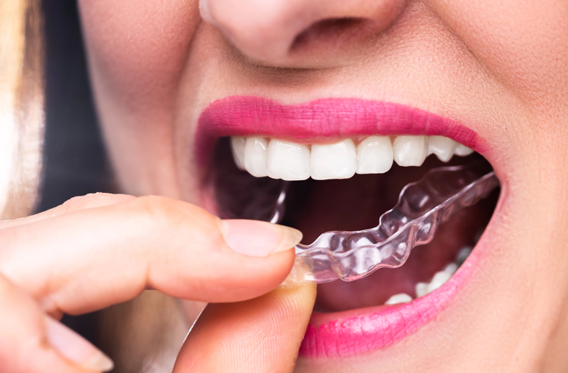 Invisible Braces 1 of 3