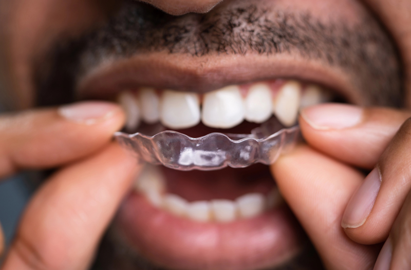 Invisible Braces 2 of 3