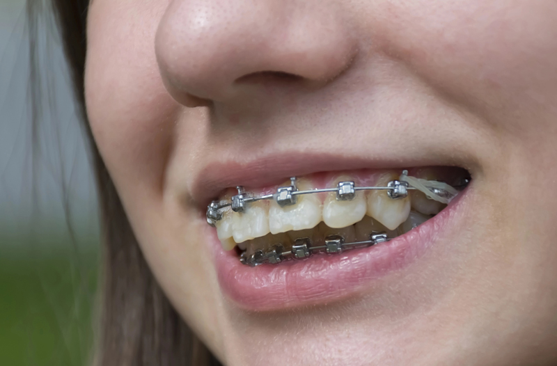 Metal Braces 2 of 3