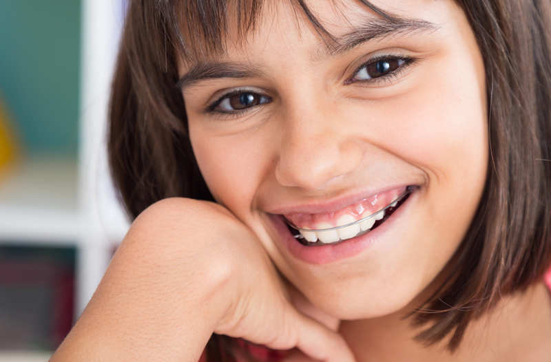 Removable Braces 1 of 3